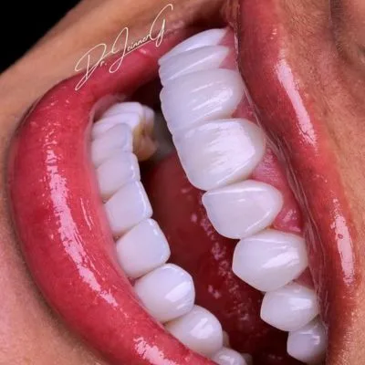 curso de carillas dentales para dentistas