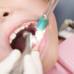 Raspado periodontal con instrumental de ultrasonidos y aspirador en la boca de un paciente