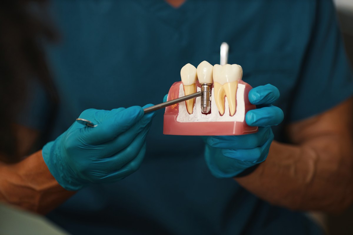 Modelo de implante dental junto a un diente natural, usado para explicar el mantenimiento periimplantario